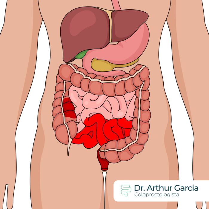 Ileocolitis