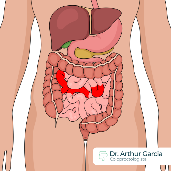 Jejunoileitis