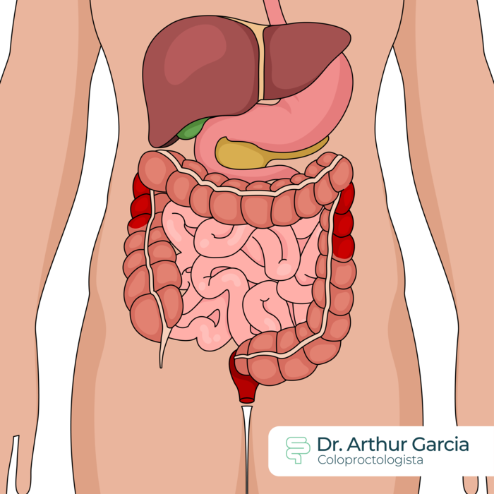 Crohn's (granulomatous) Colitis