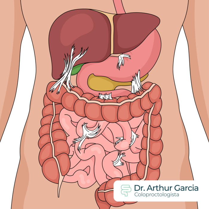 sintomas de Endometriose Intestinal