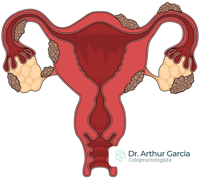 útero com Endometriose 