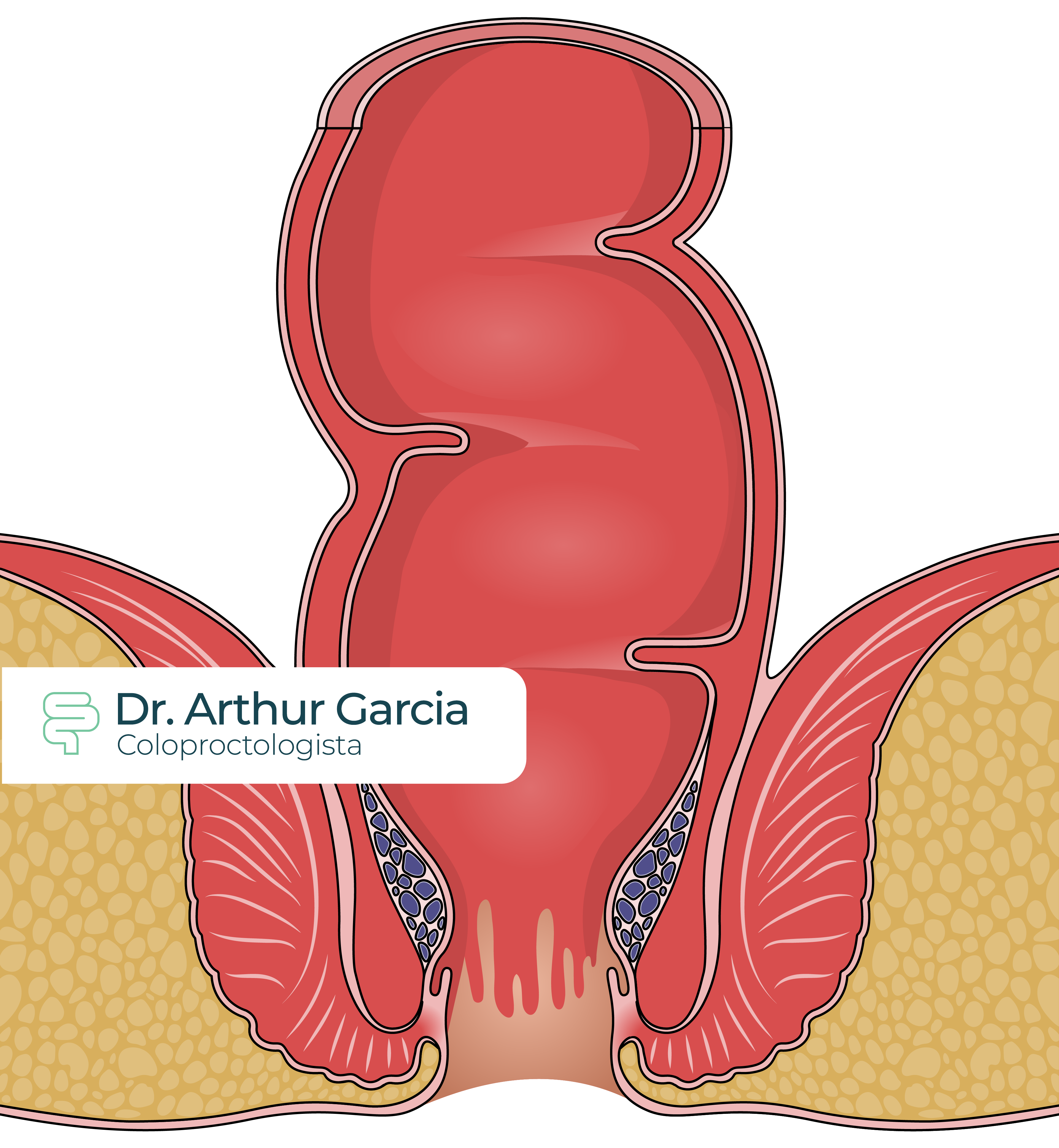 Hemorroidas - Dr. Arthur Garcia - Coloproctologista