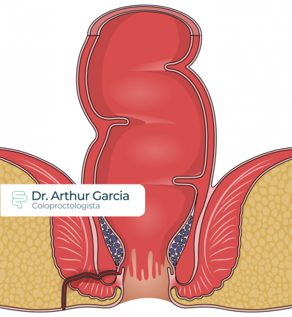 Fístula Anal